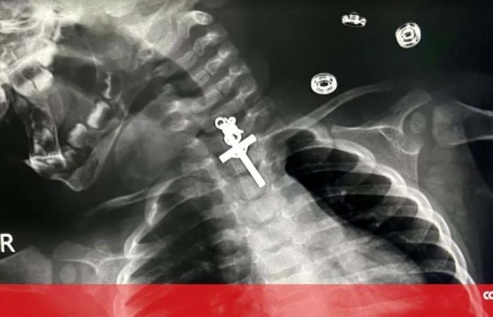 Doctors operate on baby who swallowed metal crucifix in Peru – World