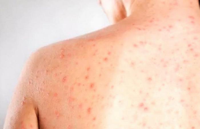 Number of measles cases in Portugal rises to 12 since January 11