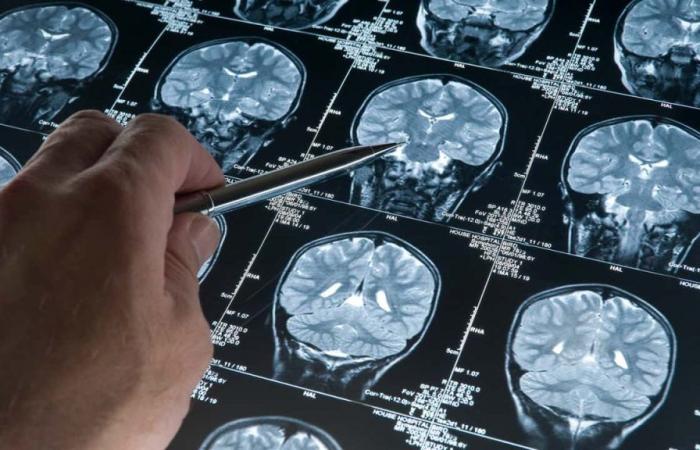 New sign of Alzheimer’s appears up to 25 years before the disease; know which