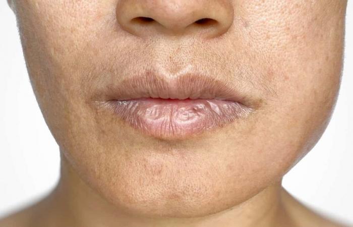 unusual sign of the disease appears on the face