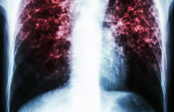 Portugal records 1,518 cases of tuberculosis in 2022 and maintains a reduction in the last six years