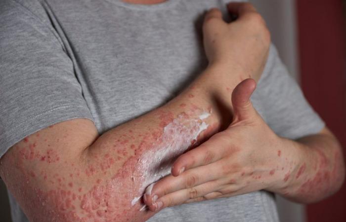 Scientists identify a genetic mutation responsible for psoriasis