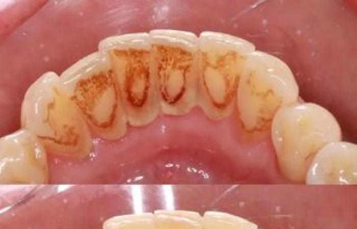 Be careful with tartar on your teeth, it can affect your heart health – Dr Diogo Coelho
