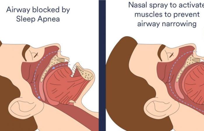 Nasal spray gives promising results against obstructive sleep apnea
