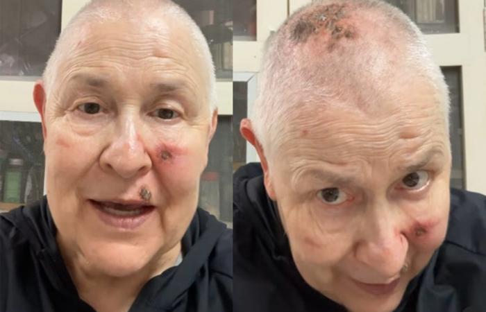 Monja Coen reveals skin cancer and reassures followers: “I’m in the healing process” | Celebrities