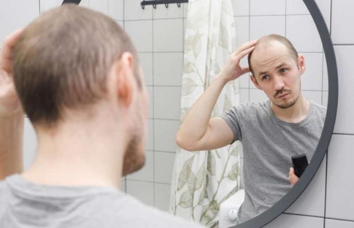 Why are more and more young men balding?