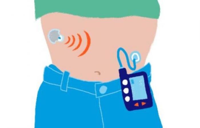 NHS in England will give “artificial pancreas” to people with type 1 diabetes