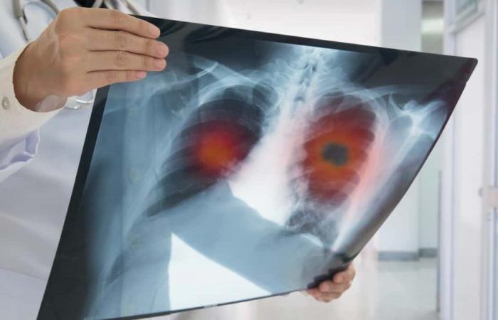 Find out how the first lung cancer vaccine works