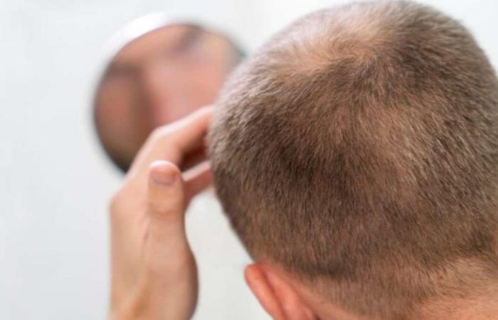 Find out how to deal with baldness and the secrets to prevent hair loss