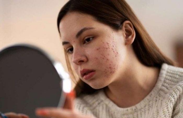 Secondhand smoke increases the risk of atopic dermatitis in adolescents – Jornal Estado de Minas
