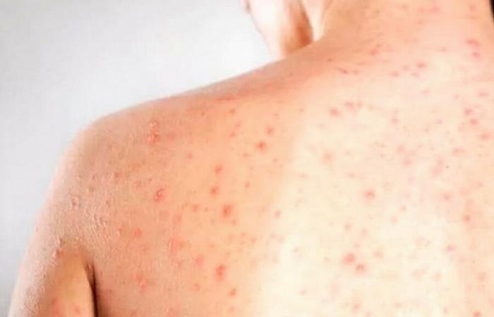 Measles cases rise to 23 in Portugal