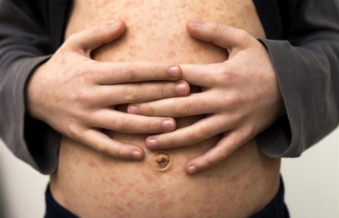 Measles cases rise in Portugal
