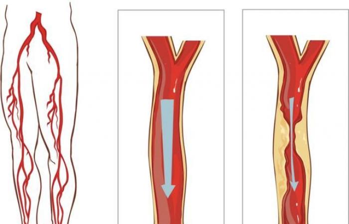 From Good to Life: The importance of the soleus muscle, nicknamed the “second heart”
