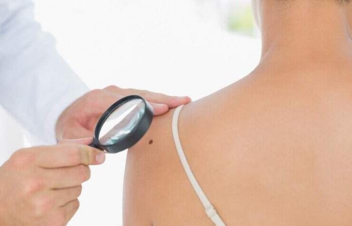 First vaccine against skin cancer begins to be tested on humans