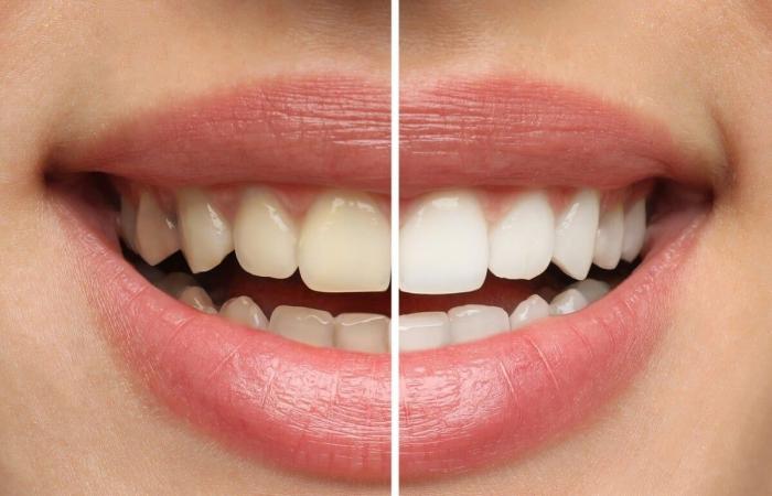 The Gazette | 3 risks of home teeth whitening for oral health