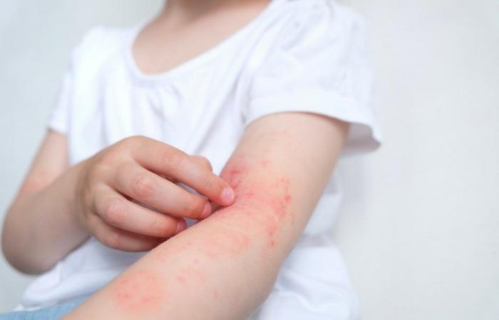Skin diseases threaten the emotional well-being of children; understand