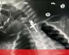 Doctors operate on baby who swallowed metal crucifix in Peru – World