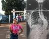 “Abandoned” by SUS, teenager waits 1 and a half years for scoliosis surgery – Direto das Ruas