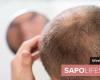 Does creatine cause baldness? A doctor’s explanations – Current affairs