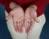 Scientists identify a genetic mutation responsible for psoriasis