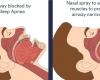 Nasal spray gives promising results against obstructive sleep apnea