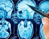 Neurological diseases are becoming more common; understand