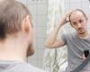 Why are more and more young men balding?