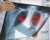 Find out how the first lung cancer vaccine works