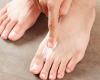 Five tricks to get rid of foot fungus
