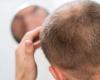 Find out how to deal with baldness and the secrets to prevent hair loss