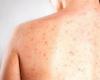 Measles cases rise to 23 in Portugal