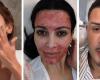 Celebrities use salmon semen, bee stings and even blood on their skin