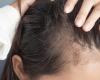 Dermatologist reveals the main reasons for losing hair