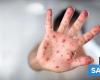 Two new cases of measles confirmed in the last week – News
