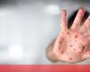 Two new cases of measles confirmed in the last week in Portugal – Society