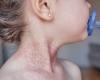 Children with chronic skin conditions face significant stigma