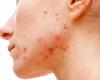 Myths and Truths about acne in adult women