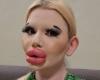 woman with the biggest lips in the world shocks the web and receives warning from doctors