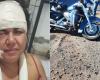 Businesswoman receives more than 60 stitches on her face and breaks her arm in a motorcycle accident at a construction site without signs