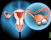 Ovarian cancer is the gynecological cancer with the highest mortality rate in Portugal – Health – SAPO.pt