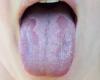 White tongue can indicate serious health problems; see causes and treatments